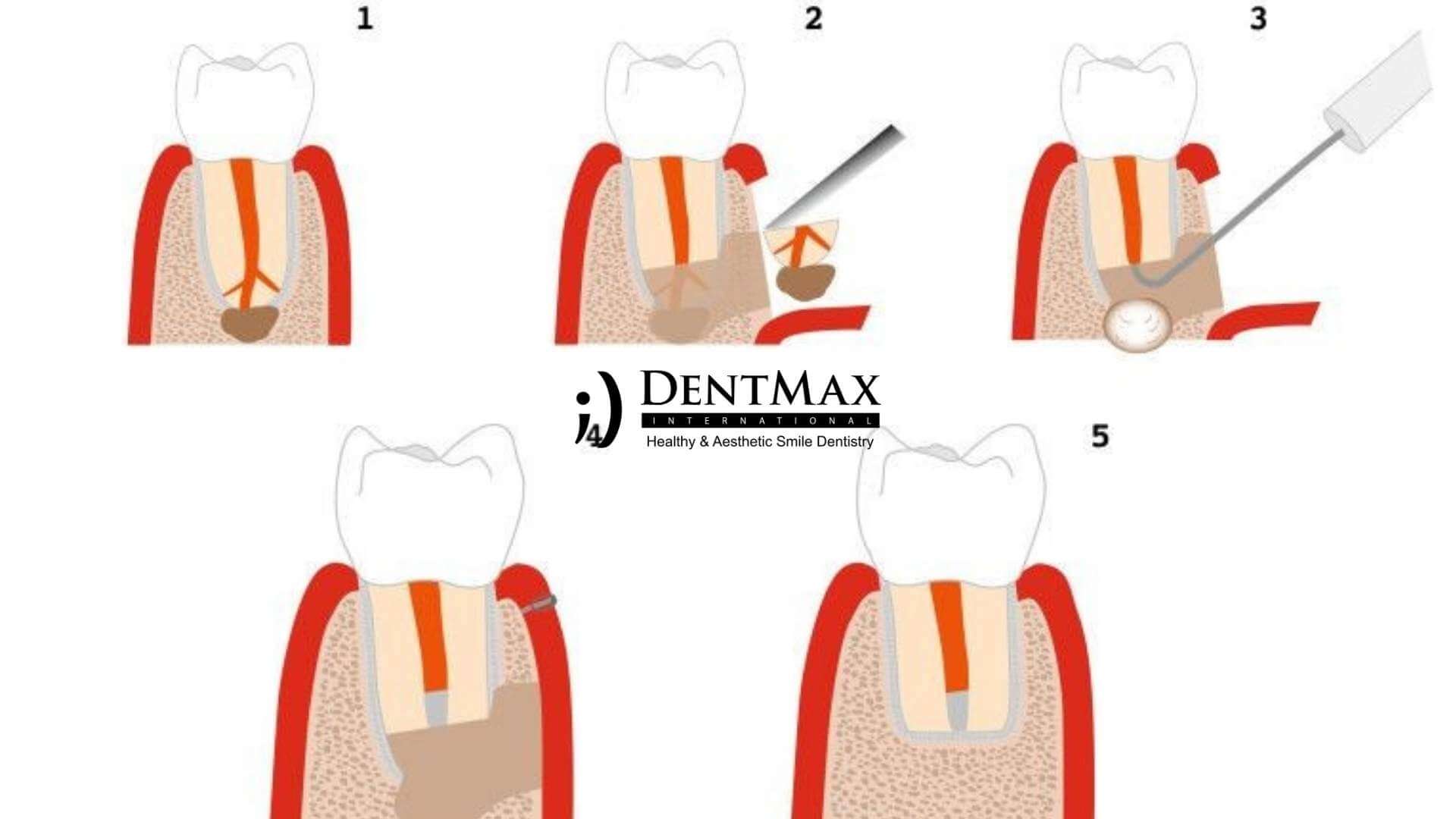 Dentmax Tedaviler