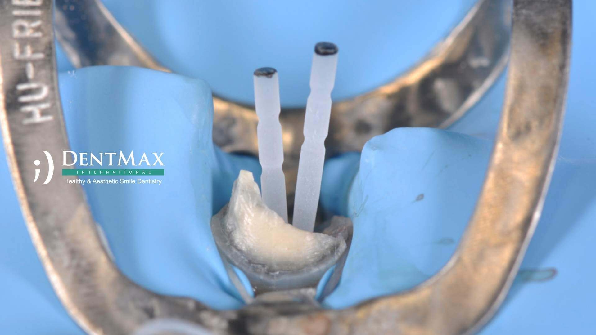 Dentmax Tedaviler