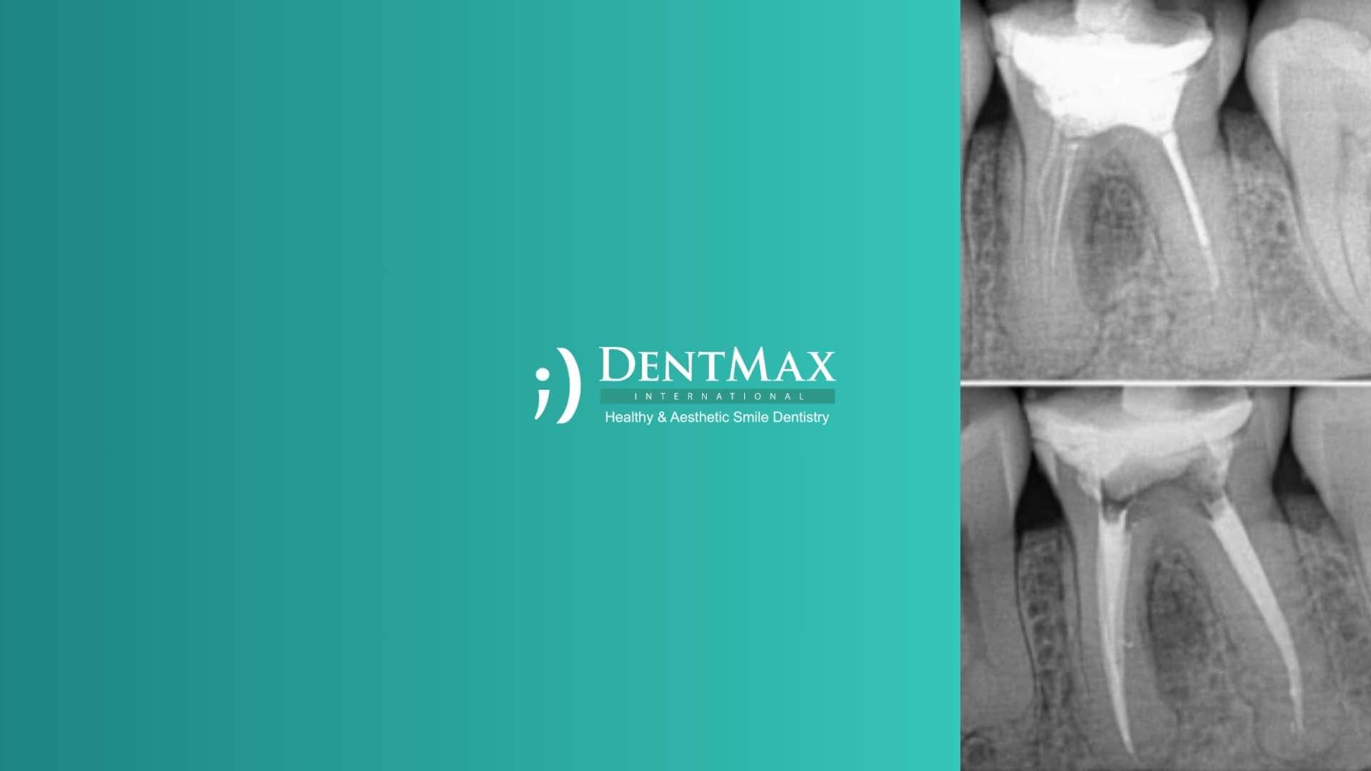 Dentmax Tedaviler