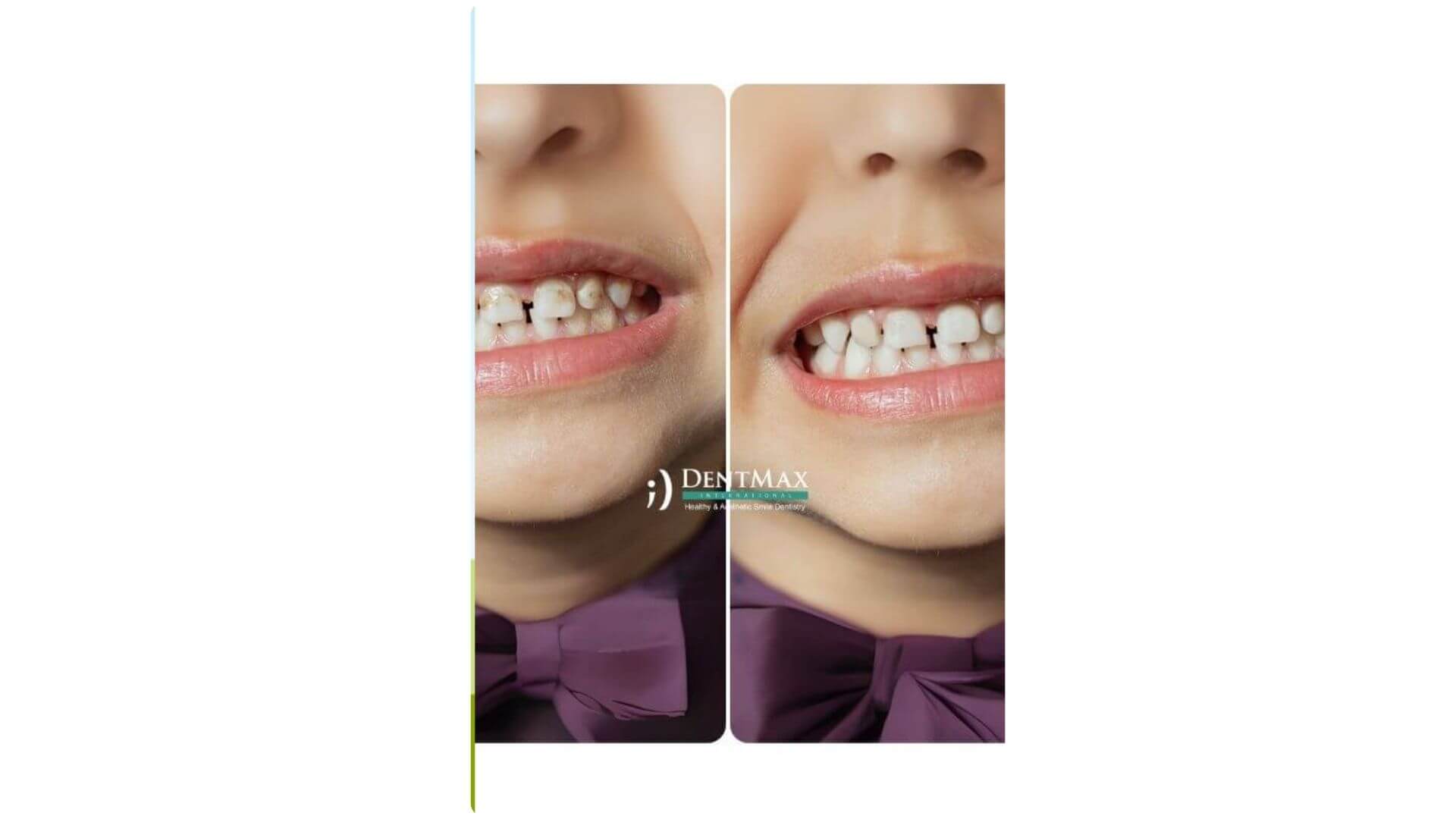 Dentmax Banner
