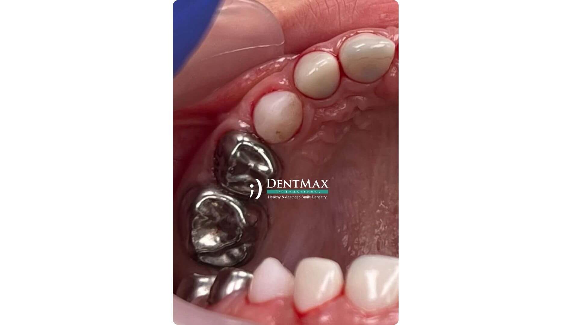 Dentmax Banner