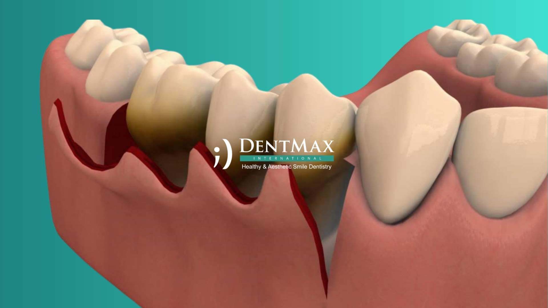 Dentmax Tedaviler