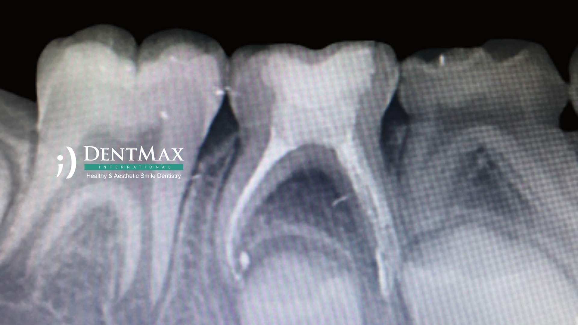 Dentmax Tedaviler