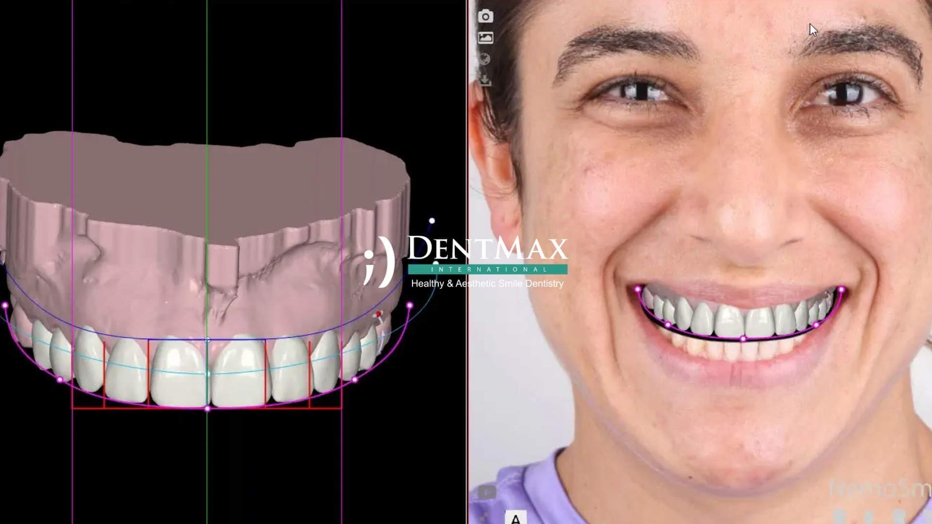 Dentmax Basından