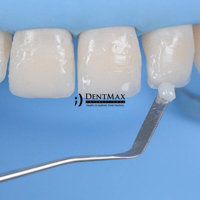 Dentmax