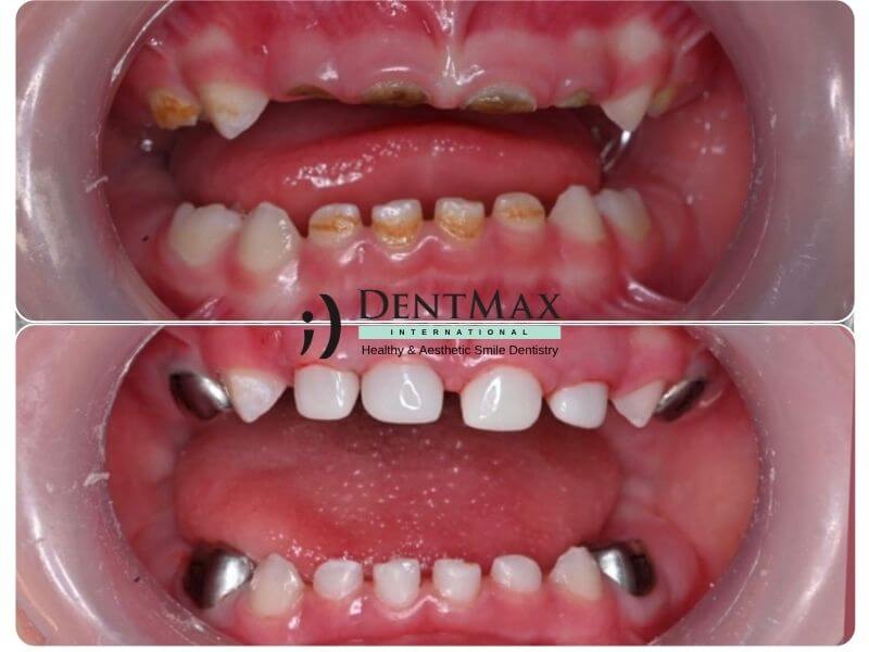 Dentmax
