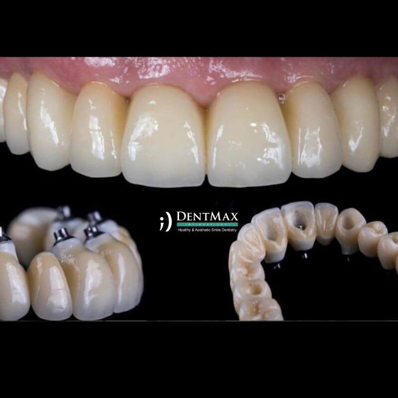 Dentmax