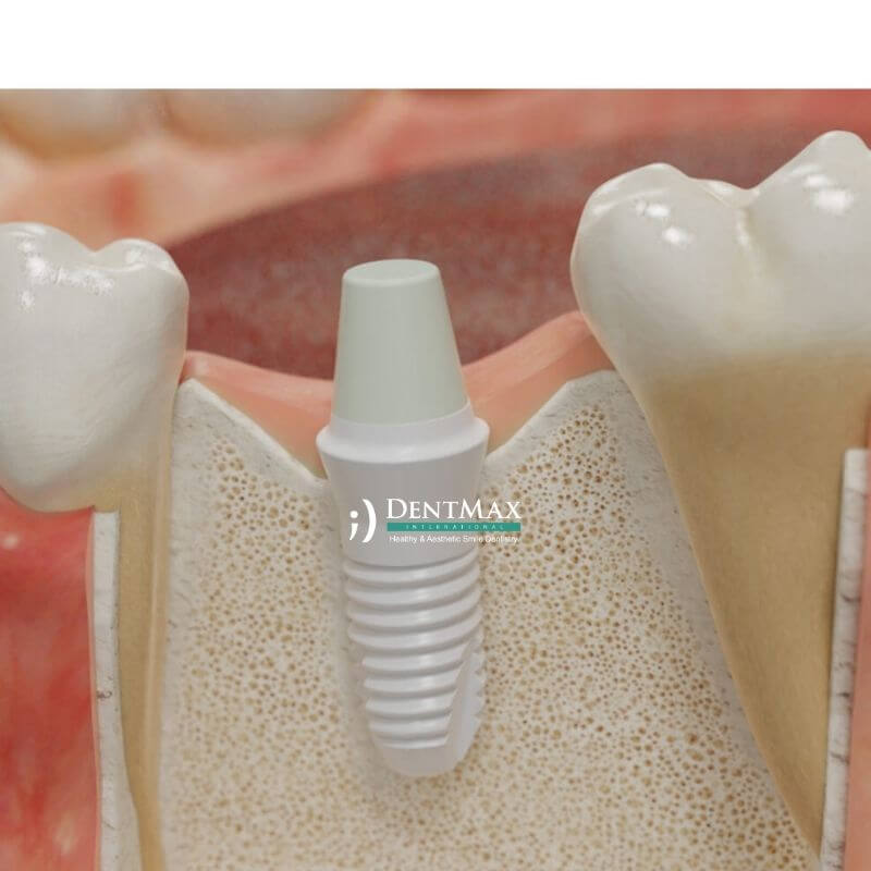Dentmax