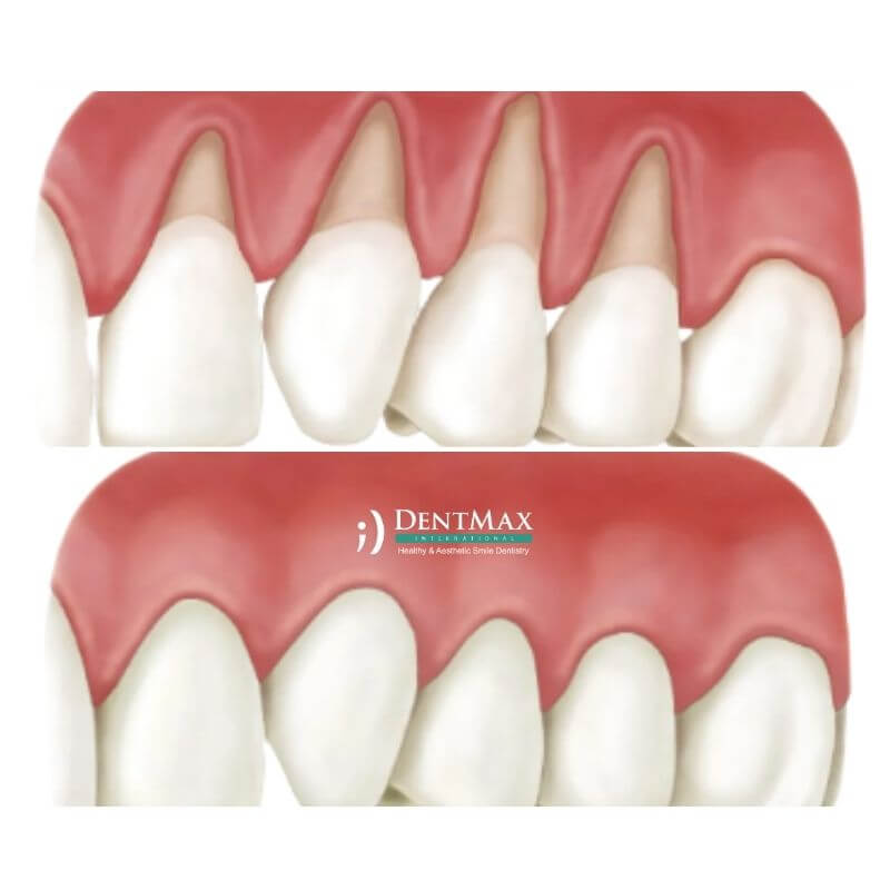 Dentmax