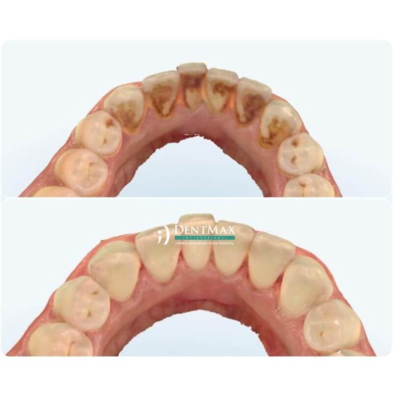 Dentmax