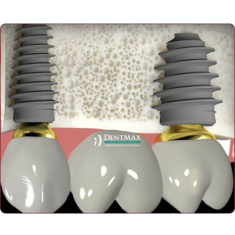 Dentmax