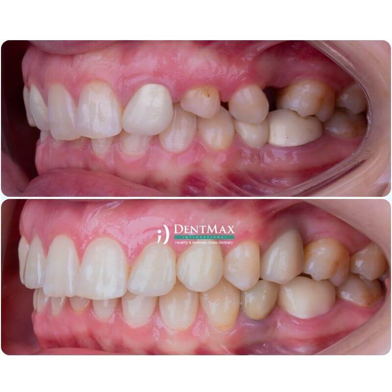 Dentmax
