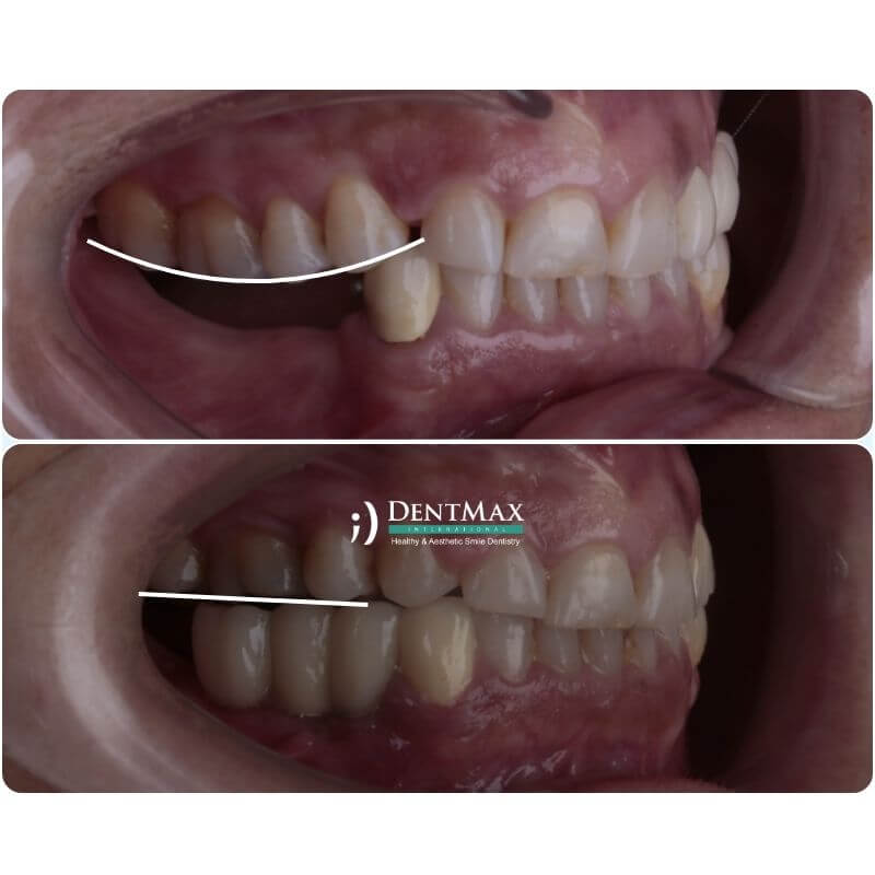 Dentmax