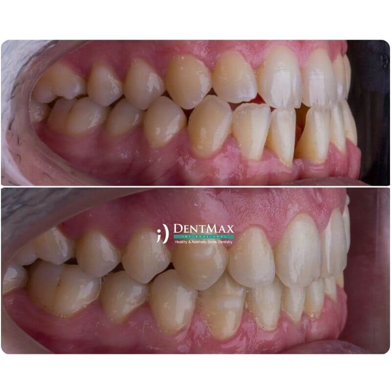 Dentmax