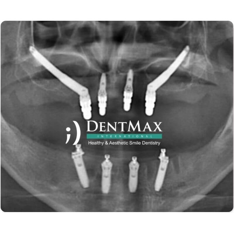 Dentmax